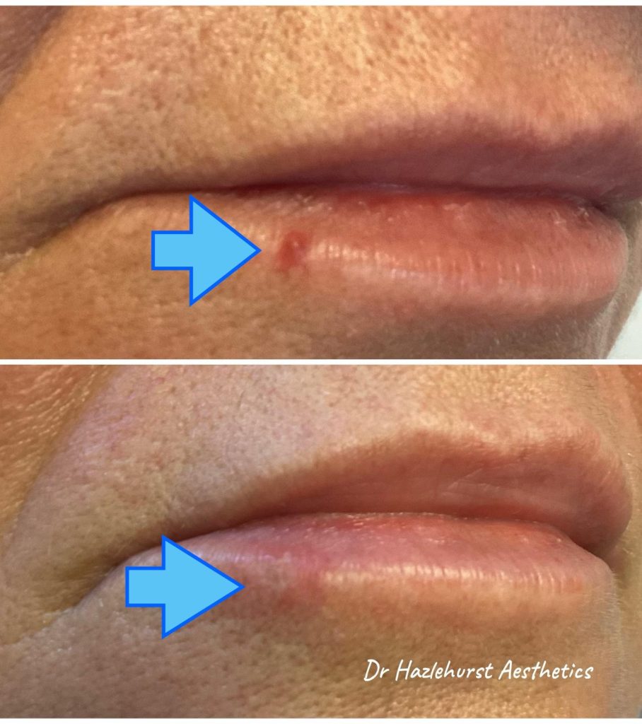 before and after electrolysis electrocautery of venus lake