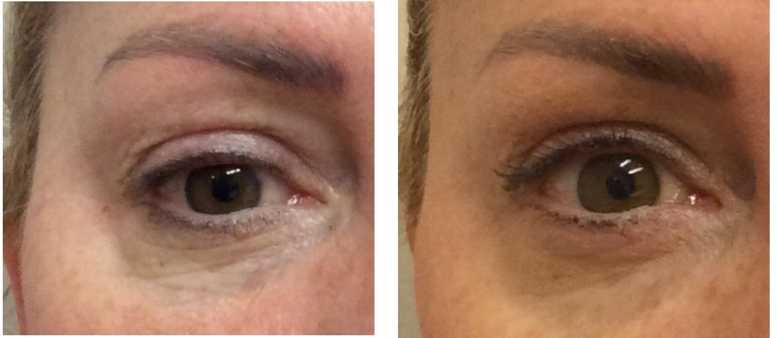 Cheshire Lasers Ultraformer Wrinkle Treatment Before and Afters