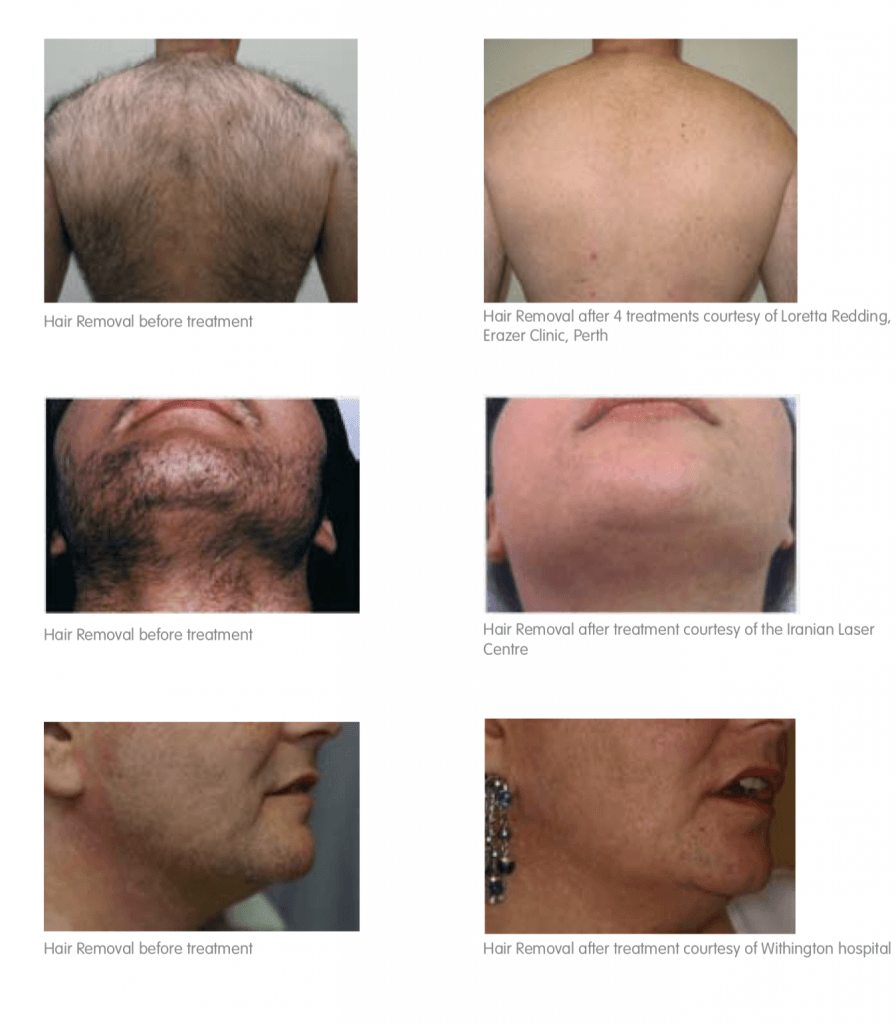 laser treatment for chin hair removal