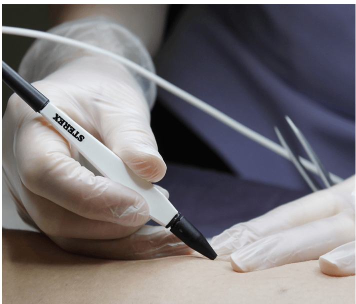 Advanced Electrocautery at Cheshire Lasers, Middlewich.