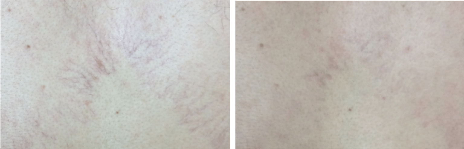 Laser red vein removal for the Face at Cheshire Lasers, Middlewich