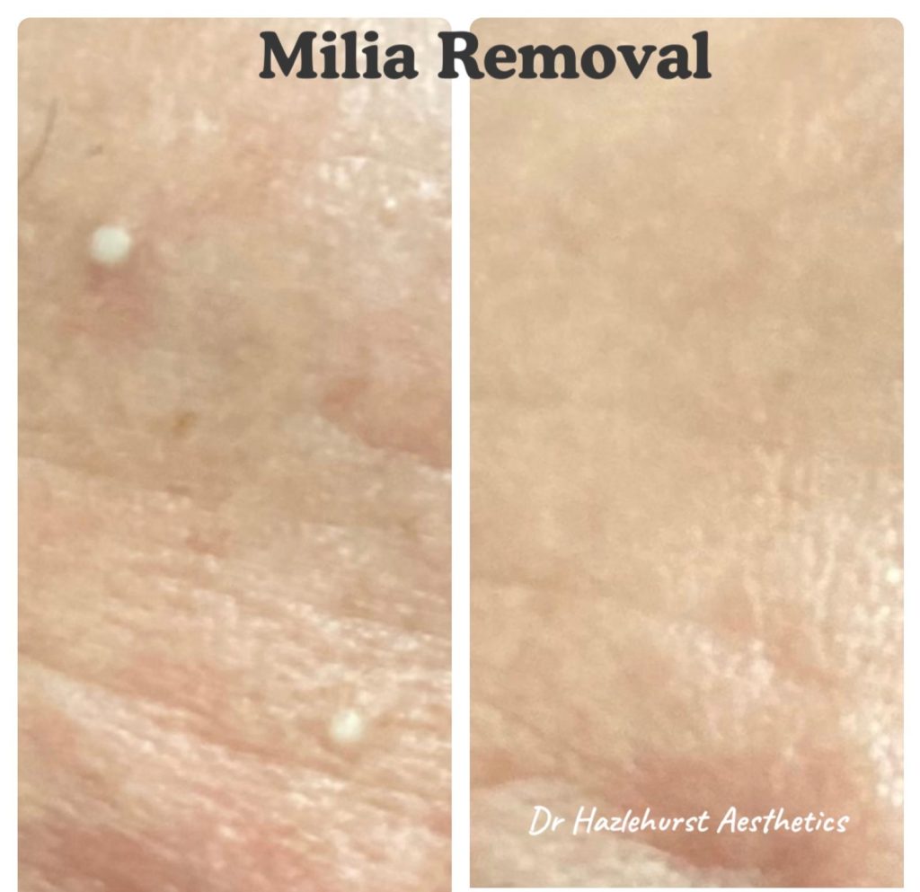 before and after electrolysis electrocautery of milia
