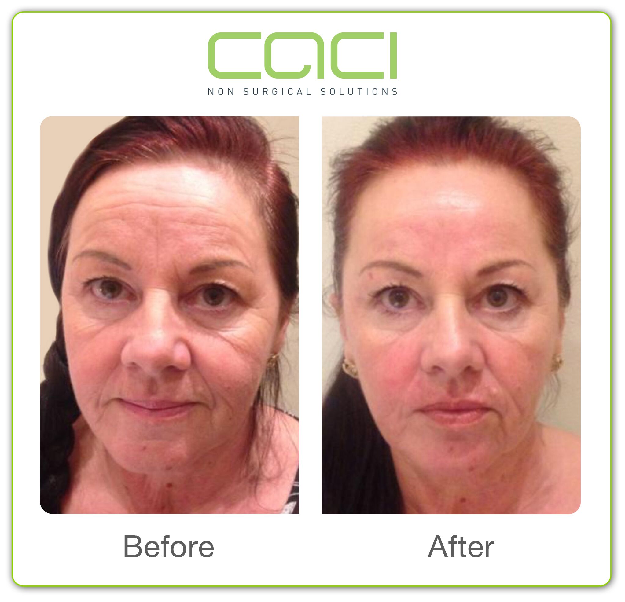 View some CACI Treatment before and ater images