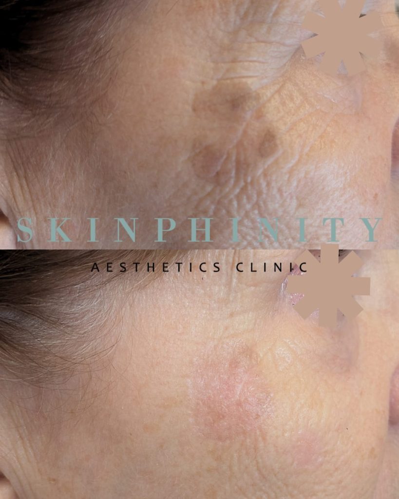 Before and after cryotherapy to pigmentation