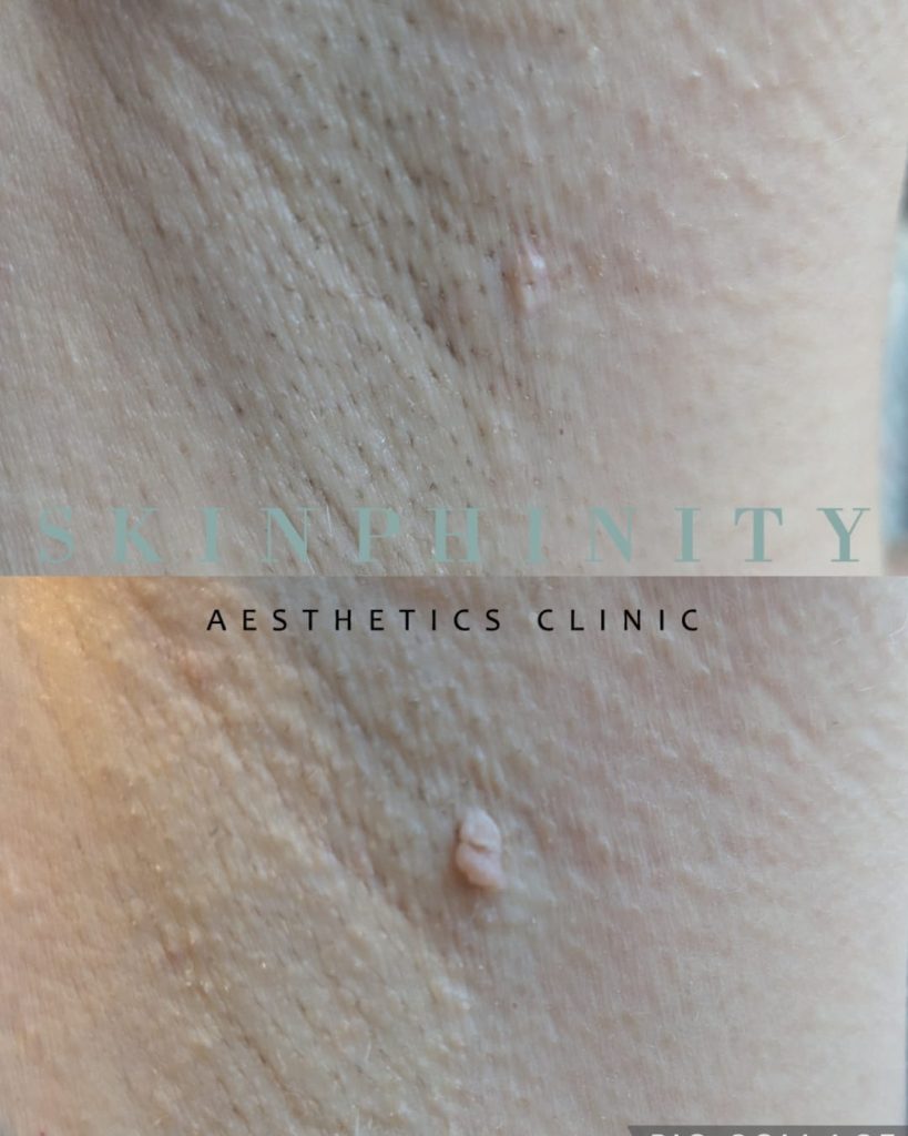 A skin tag before and after treatment