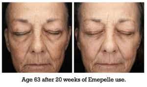 Age 63 after 20 weeks of Emepelle use.
