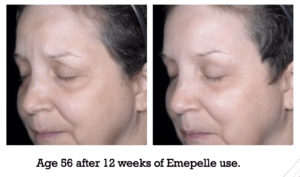 Age 56 after 12 weeks of Emepelle use.