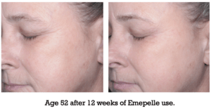 Age 52 after 12 weeks of Emepelle use.