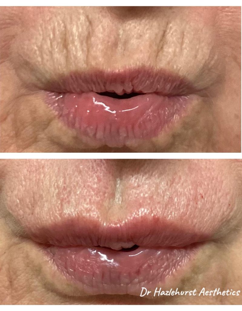Lips before and after treatment, example 12