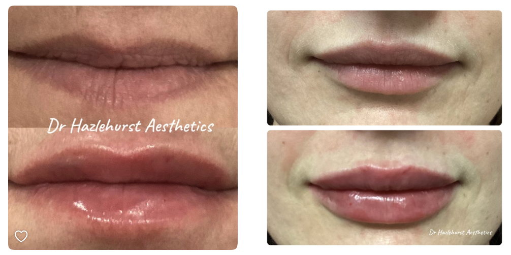 Lips before and after treatment, example 7