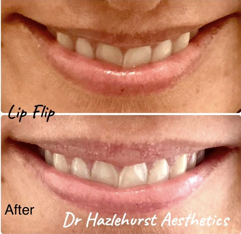 Lips before and after a lip flip