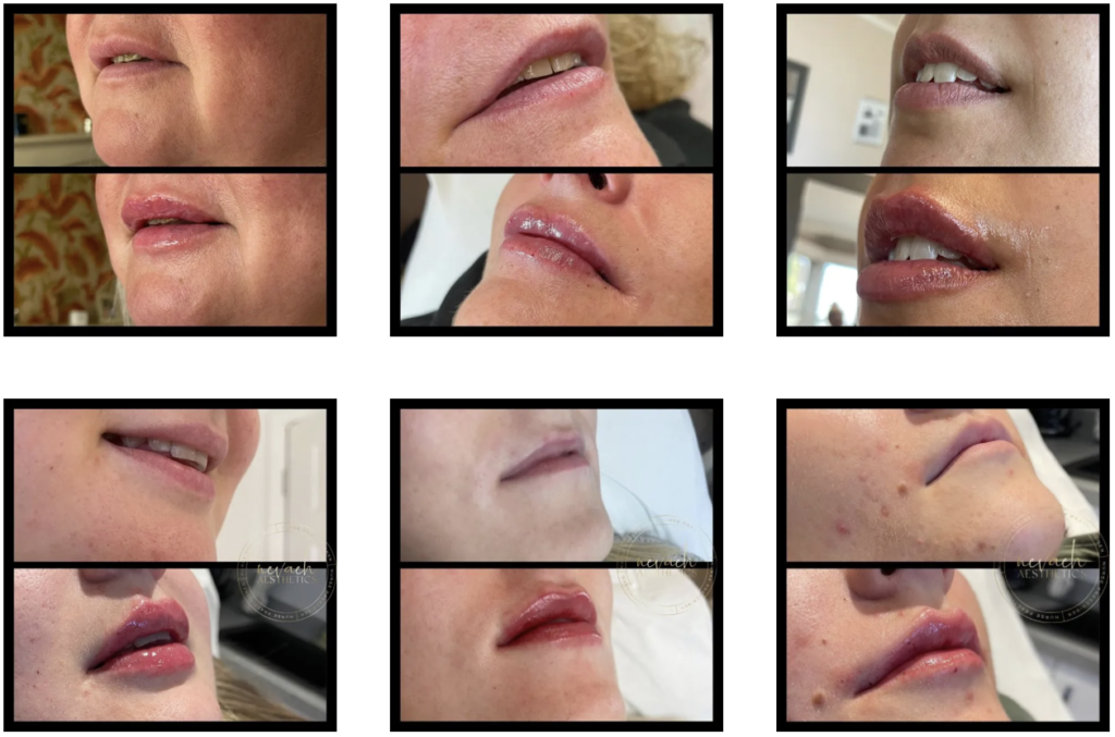 Before and after lip enhancement treatment with dermal fillers by Katey Moulton