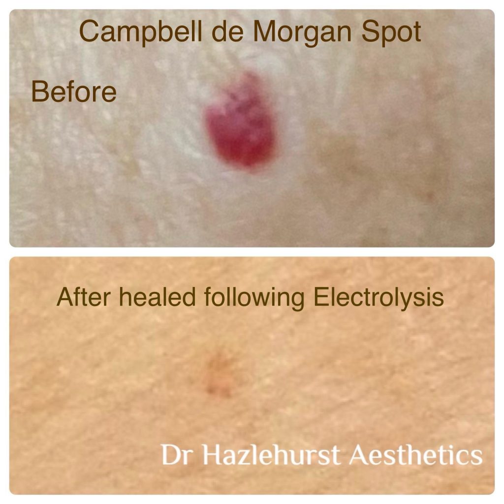 before and after electrolysis electrocautery