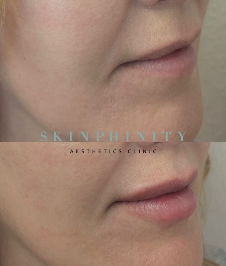 Lips before and after treatment, example 8