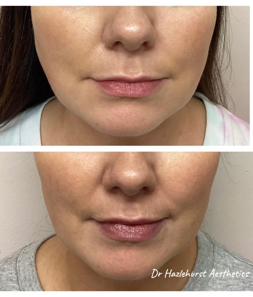 Before and after Masseter botox with Dr Kathryn Hazlehurst