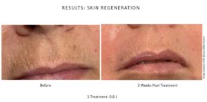 Upper lip Neogen Plasma treatment on a low setting 