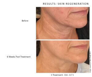 before and after Neogen Neck Treatment