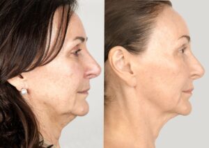 Shirley Ballas before and after her second round of six sessions of NeoGen Plasma. 