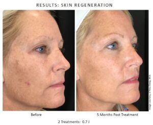 before and after Neogen Plasma Face Treatment 