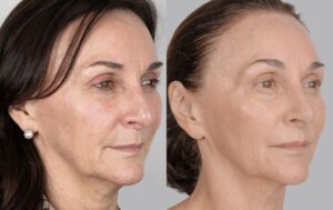 Shirley Ballas before and after her second round of six sessions of NeoGen Plasma. 