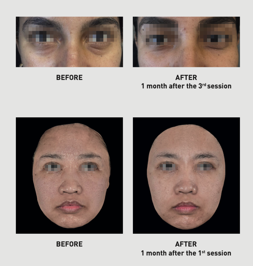 Juvelook under eye skin rejuvenation treatment before and after