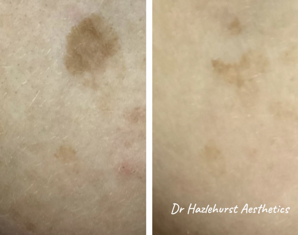 Before and after Cryotherapy to age spots with Dr Hazlehurst