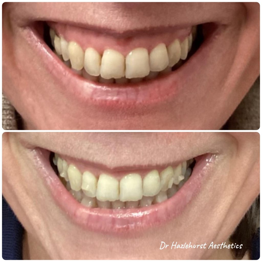 Gummy Smile Treatment with Botox