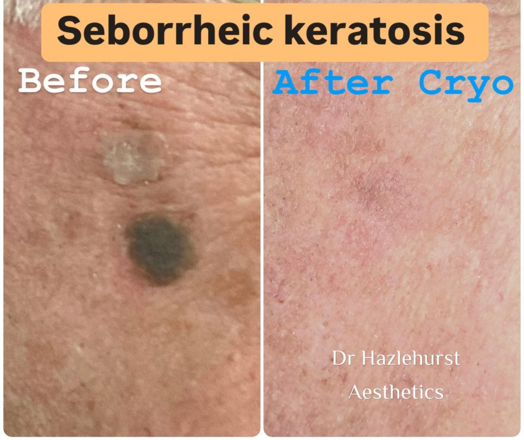 Before and after Cryotherapy to seborrhoeic keratosis with Dr Hazlehurst